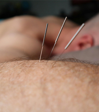 Dry Needling 4 Image Grid