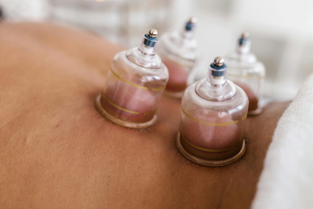 Cupping Therapy 1