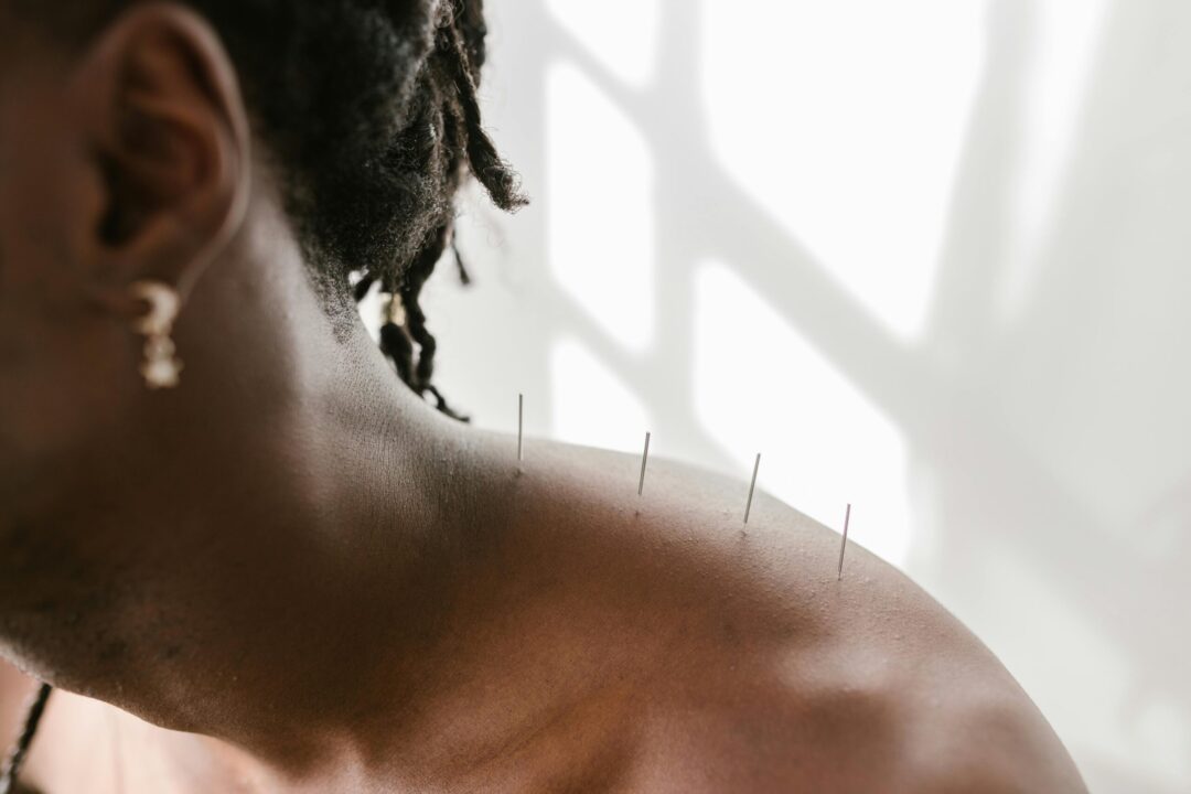 Dry Needling Muscle